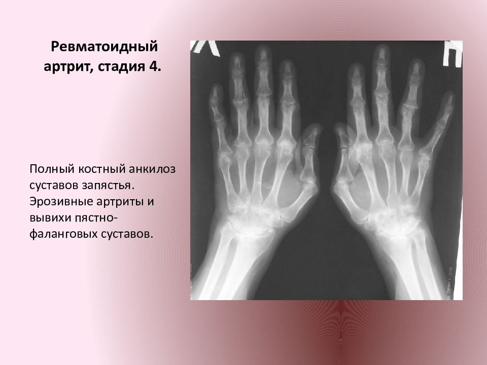 Ревматоидный артрит мышцы. Ревматоидный артрит кисти рентген. Ревматоидный артрит пястно фаланговый. Ревматоидный артрит 4 стадия рентген. Анкилоз ревматоидный артрит рентген.