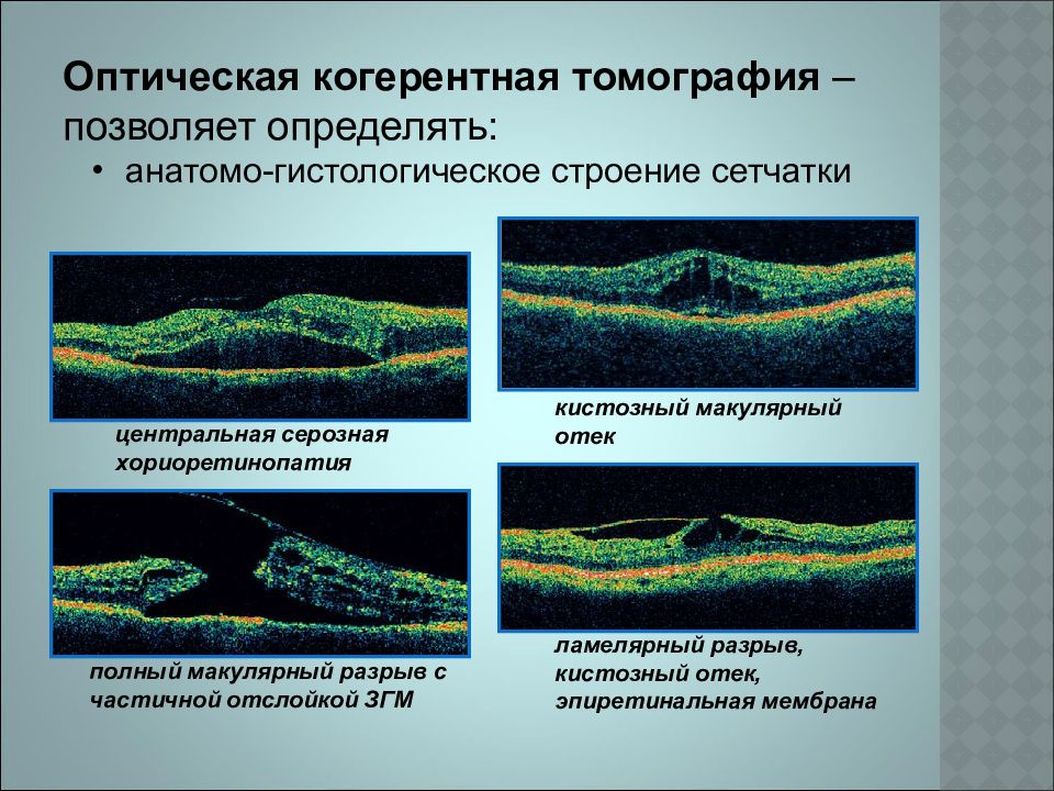 Когерентная картина. Оптическая когерентная томография. Когерентная томография сетчатки глаза. Оптическая когерентная томография макулы. Оптическая когерентная томография норма.