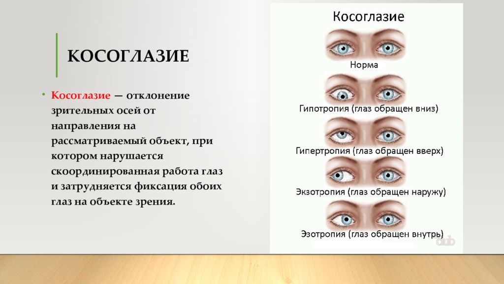 Оба зрения. Типы косоглазия. Косоглазие это кратко. Гетеротропия глаза. Косоглазие на оба глаза.