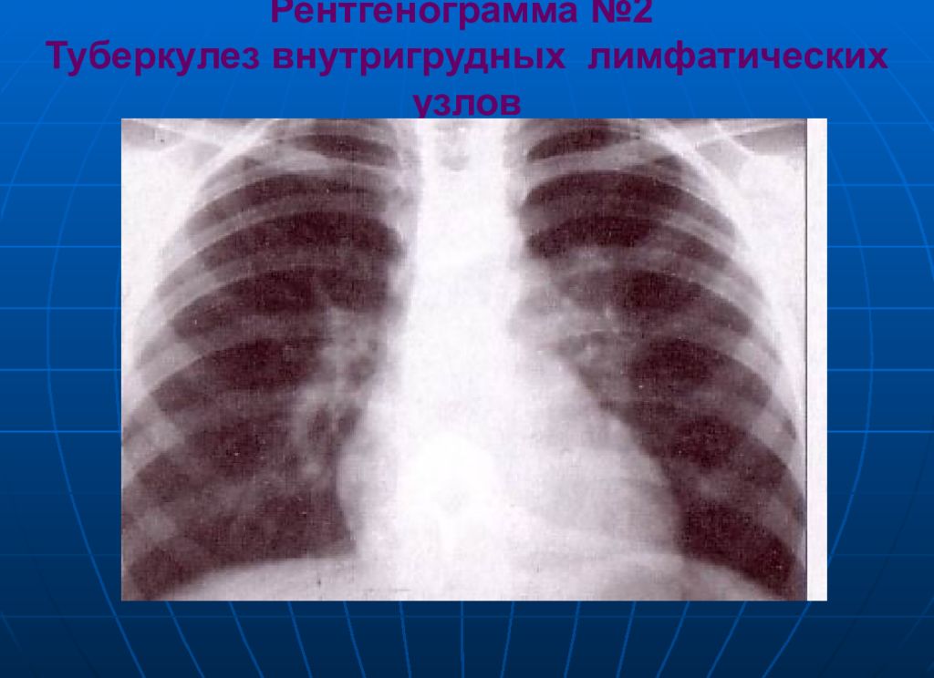 Аденопатия. Туберкулез внутригрудных лимфатических узлов рентген. Туберкулез внутригрудных лимфатических узлов рентгенограмма. Рентген при туберкулезе внутригрудных лимфатических узлов. Туберкулез лимфатических узлов рентген.
