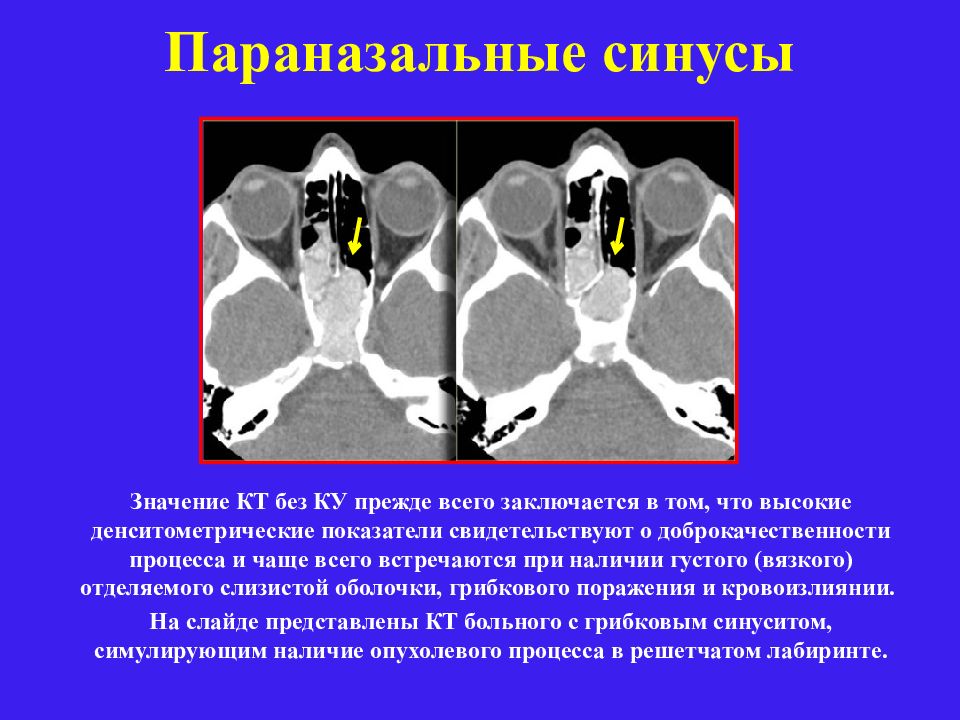 Что означает кт. Параназальные синусы. Кт параназальных синусов. Опухоли параназальных синусов. Кт значимость.