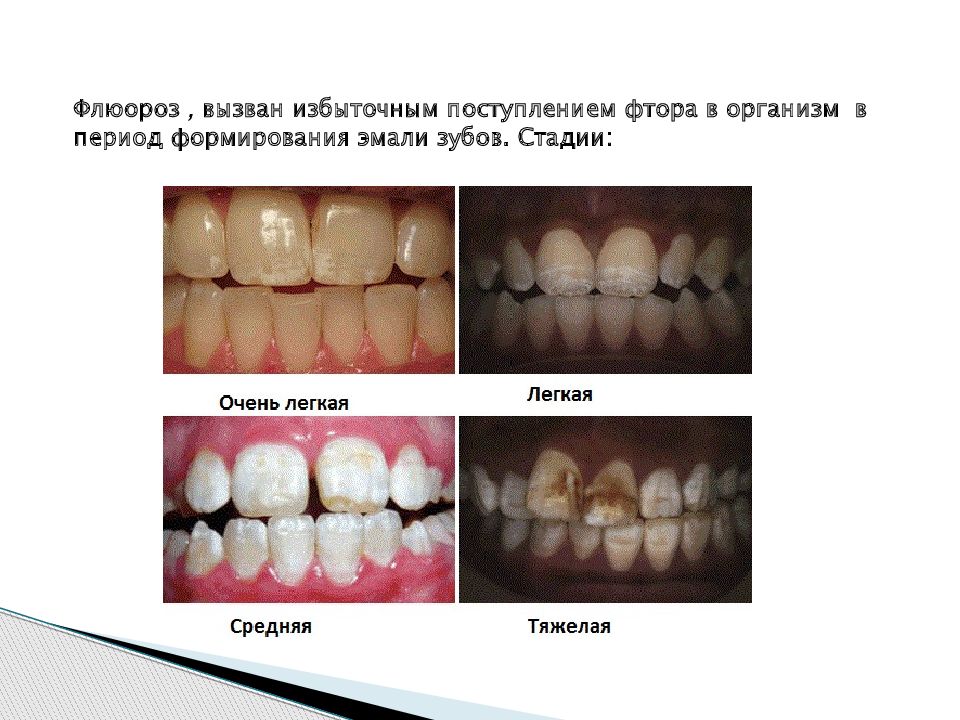 Заболеваниями сходными по клинической картине с гипоплазией эмали являются