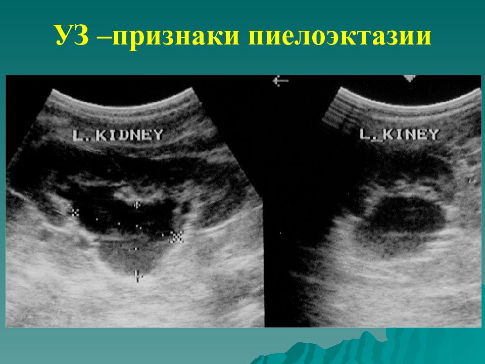 Пиелоэктазия у детей. Двусторонняя пиелоэктазия на УЗИ. Пиелоэктазия почек на УЗИ. УЗИ признаки пиелоэктазии у детей. Пиелоэктазия по УЗИ критерии.