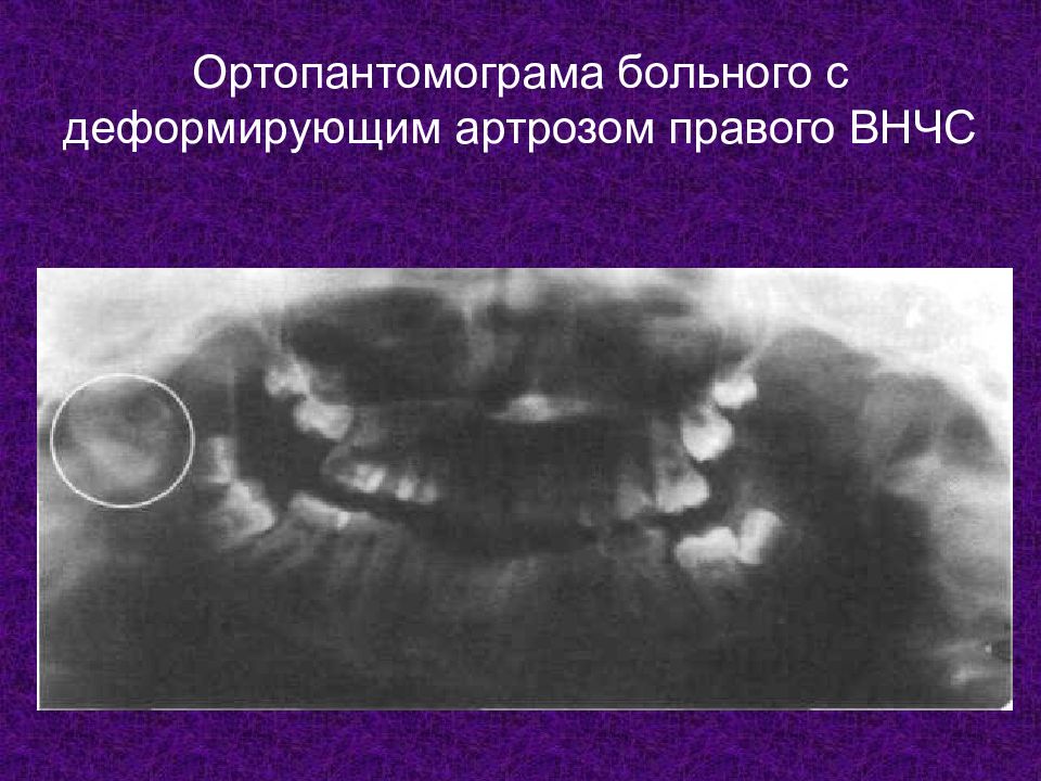 Артроз внчс презентация