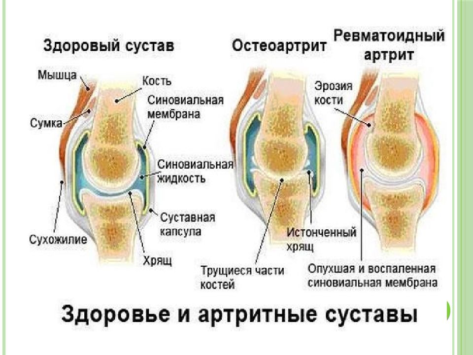 Ревматоидный артрит мышцы. Ревматический артрит локализация. Локализация поражения суставов при ревматоидном артрите. Ревматоидный артрит коленного сустава. Ревматоидный артрит с доа это.