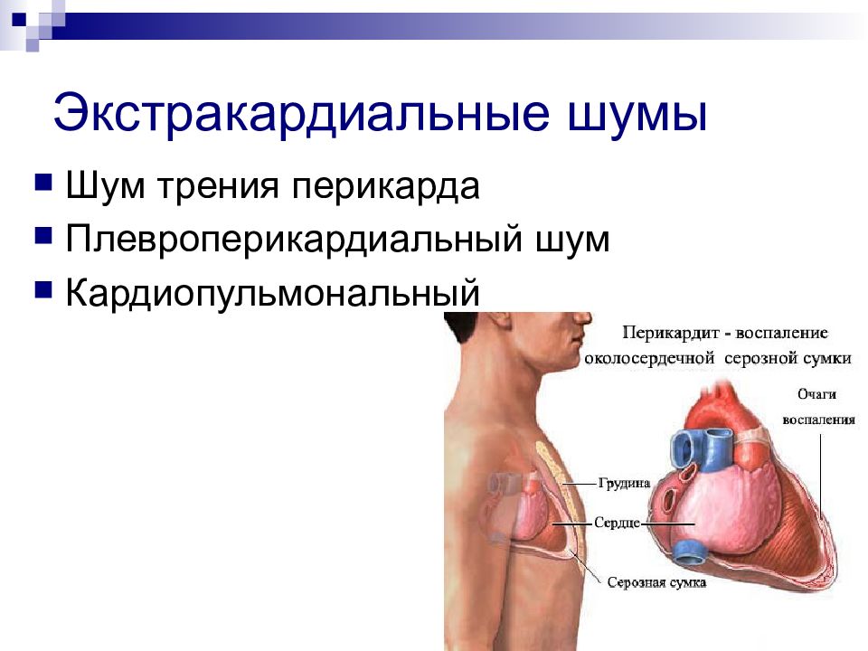 Шумы в сердце. Перикардит шум трения перикарда. Ранение сердца и перикарда. Аускультация сердца шумы.