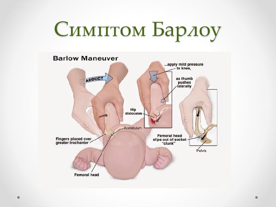 Симптом Барлоу