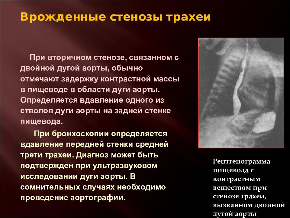 Стеноз у ребенка. Врожденный стеноз трахеи. Врожденные стенозы трахеи и бронхов. Врожденные заболевания трахеи. Рубцовый стеноз трахеи.