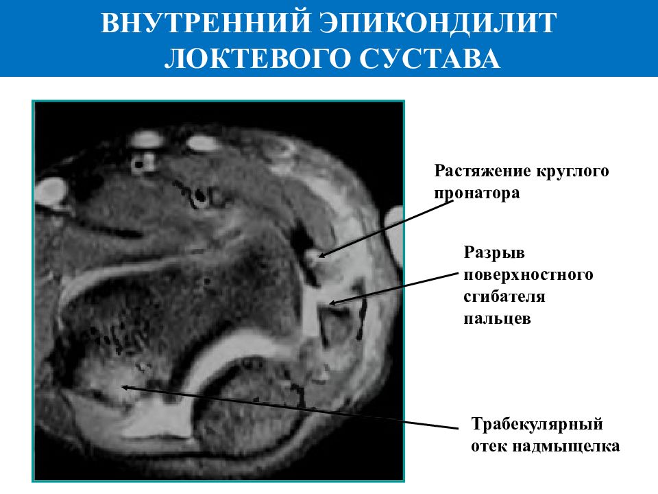 Трабекулярный отек сустава. Внутренний эпикондилит мрт. Наружный эпикондилит локтевого сустава мрт. Эпикондилит локтевого сустава мрт. Латеральный эпикондилит мрт.