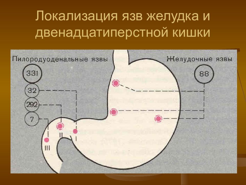 Язвенная болезнь 12 перстной кишки картинки