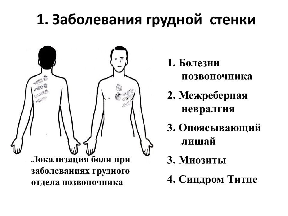 Невралгия грудной клетки симптомы у взрослых