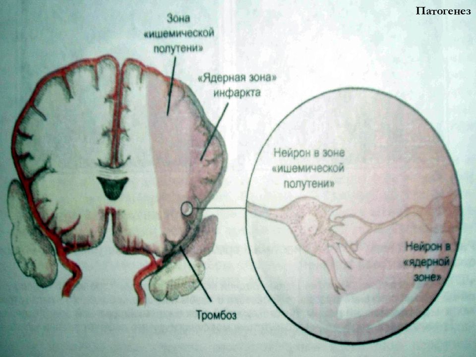 Патогенез мозговых нарушений. Зоны кровоснабжения головного мозга. Нарушения мозгового кровообращения патогенез. Бассейны кровоснабжения головного мозга схема мрт.