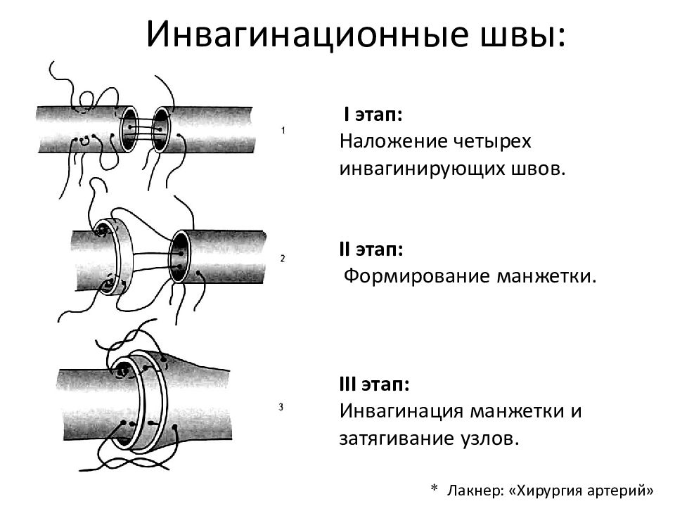 Шов артерий