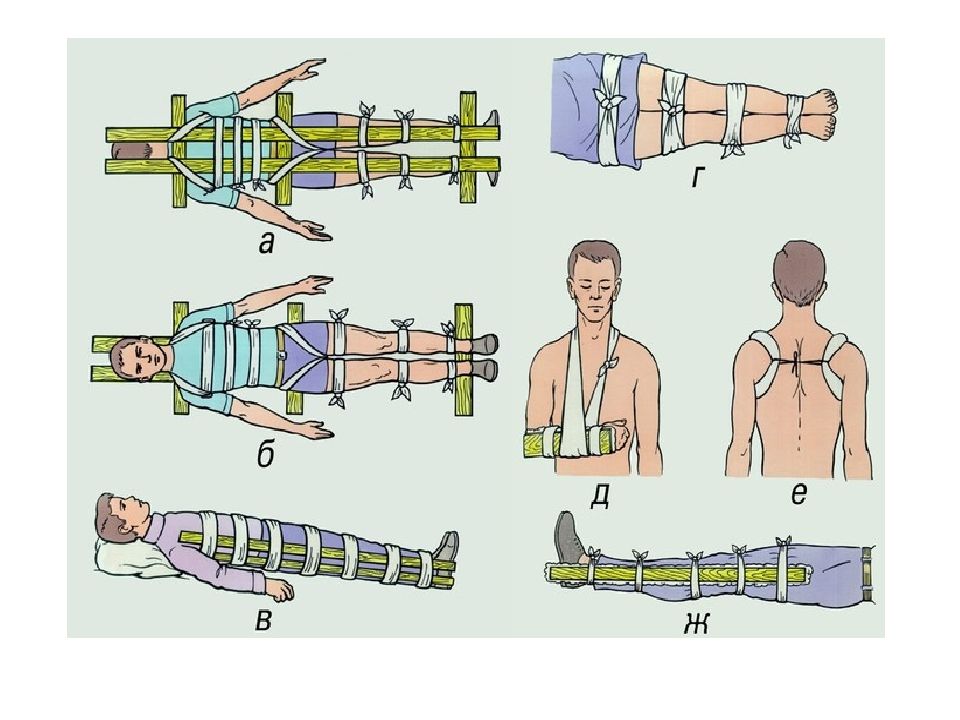Иммобилизация травмированной конечности. Иммобилизация конечности при переломе. Методы иммобилизации при переломе костей конечностей. Иммобилизация конечности при переломе позвоночника. Наложение шины при переломе позвоночника.