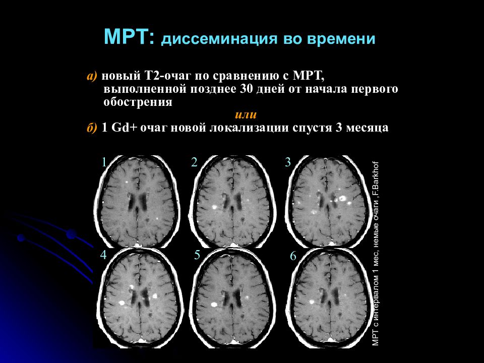 Для картины магнитно резонансной томографии при рассеянном склерозе характерны очаги