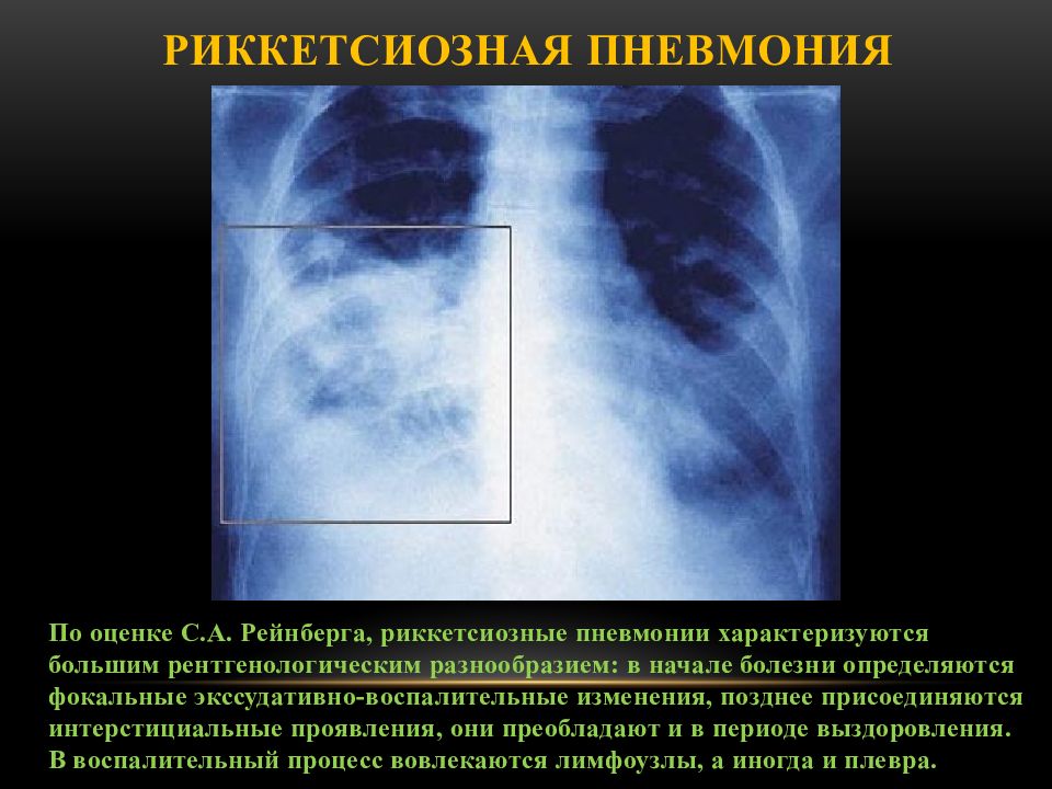 Пневмония ходит. Риккетсиозная пневмония. Ку риккетсиозная пневмония. Пневмония выздоровление. Пневмония симптомы выздоровления.