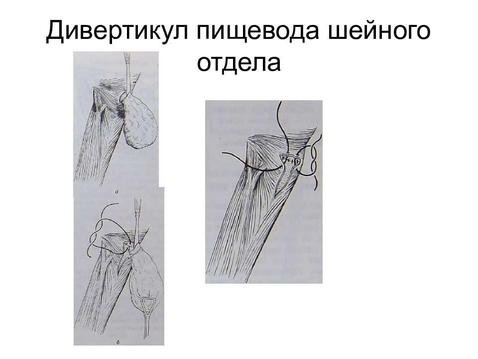 Отдел операции. Дивертикул шейного отдела пищевода. Дивертикул пищевода шейного отдела операция. При дивертикуле шейного отдела пищевода. Операции на шейном отделе пищевода топографическая анатомия.