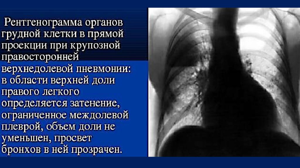 Рентген диагностика пневмоний. Рентген при крупозной пневмонии описание. Описание рентгена легких при крупозной пневмонии. Рентген лёгких при крупозной пневмонии. Рентгенологические изменения при крупозной пневмонии.