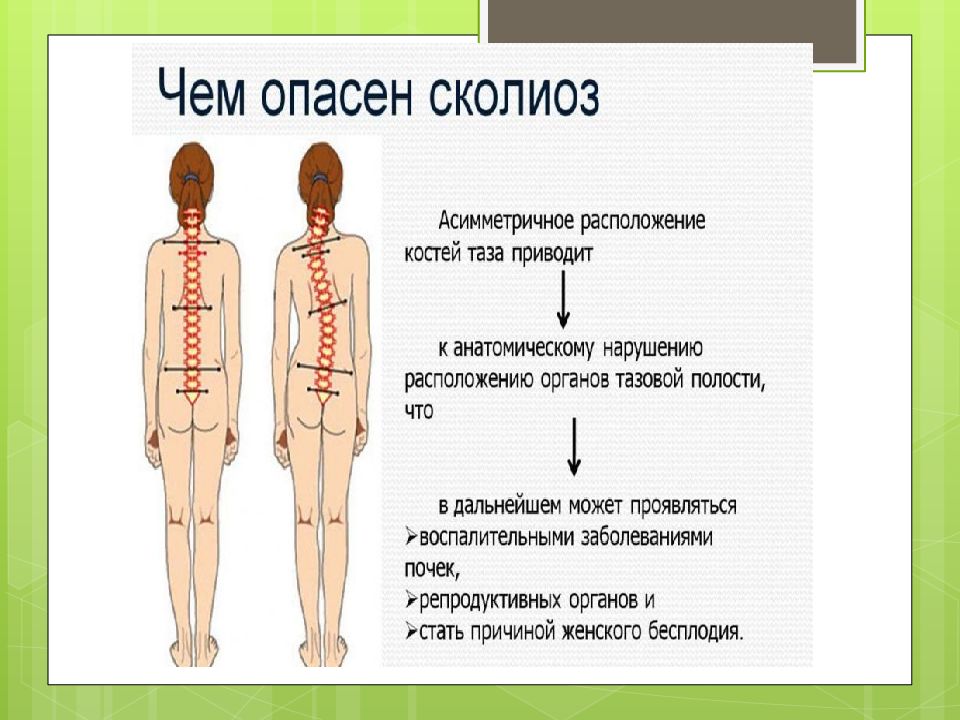 Сколиоз картинки для презентации