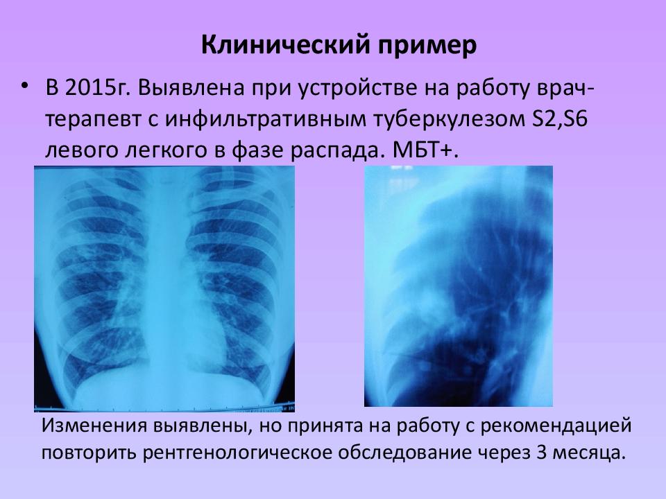 Инфильтративный туберкулез легких презентация