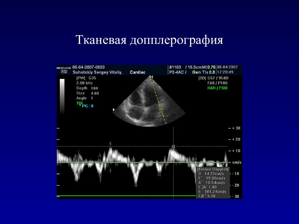 Что определяет доплер. Эхокардиография сердца тканевой допплер. Импульсный допплер эхокардиография аппарат. ЭХОКГ импульсно волновая тканевая допплерография. Импульсно волновой тканевой доплер.