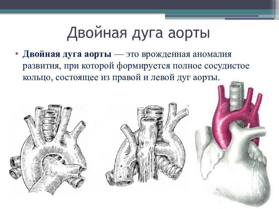 Кольцо аорта. Двойная дуга аорты аортальное кольцо. Правая дуга аорты аномалия. Аномалии сосудов дуги аорты. Правосторонняя дуга аорты на УЗИ.