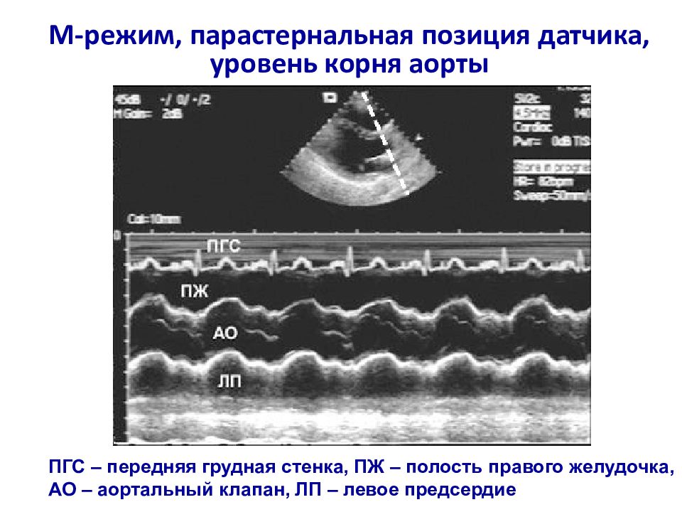 Эхокардиография сердца презентация