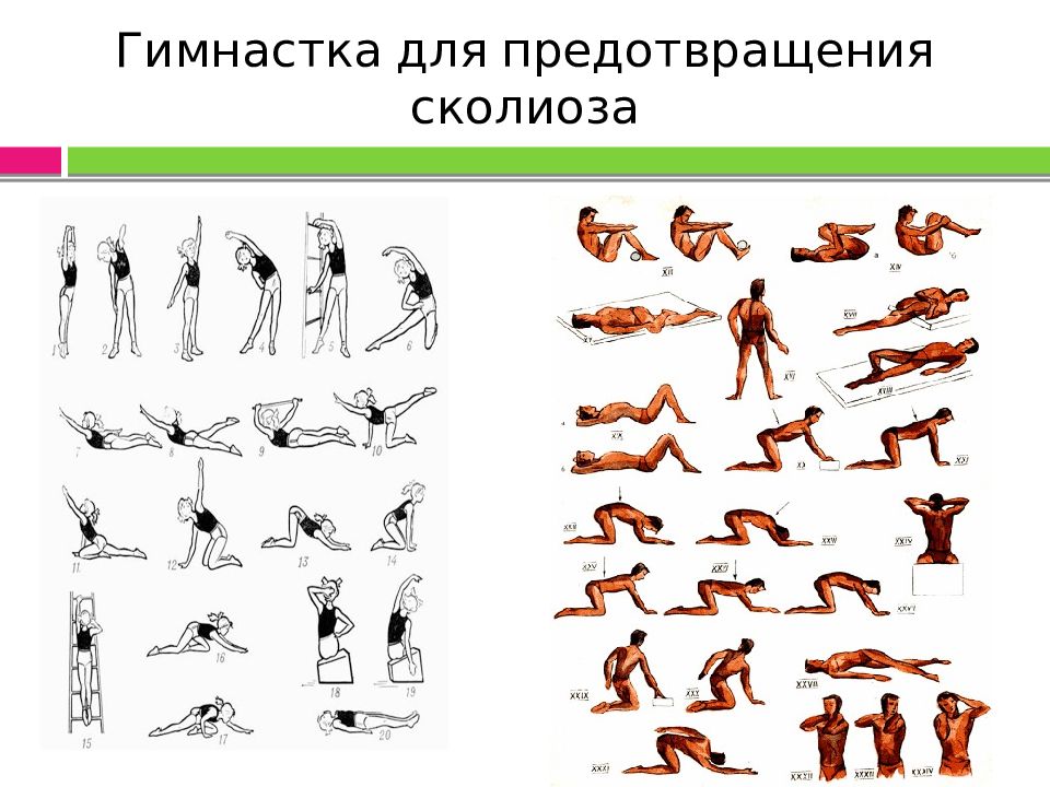 Комплекс упражнений при сколиозе с картинками и описанием