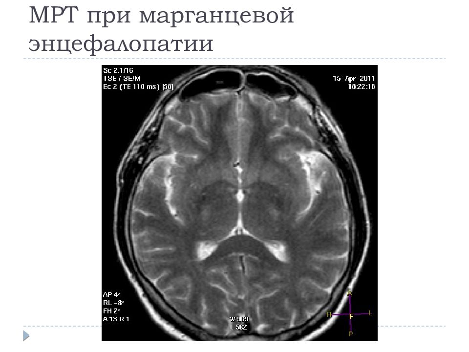 Марганцевая интоксикация. Марганцевая интоксикация на мрт. Марганцевая энцефалопатия мрт. Энцефалопатия на мрт. Отравление марганцем мрт.