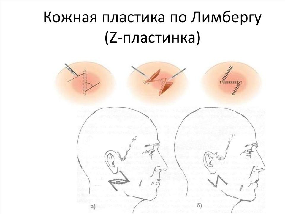 Презентация пластика местными тканями