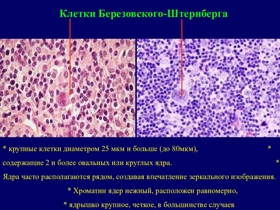 Болезнь ходжкина. Лимфогранулематоз первичный очаг. Лимфогранулематоз лимфопения. Клинические проявления лимфогранулематоза. Лимфогранулематоз у детей презентация.