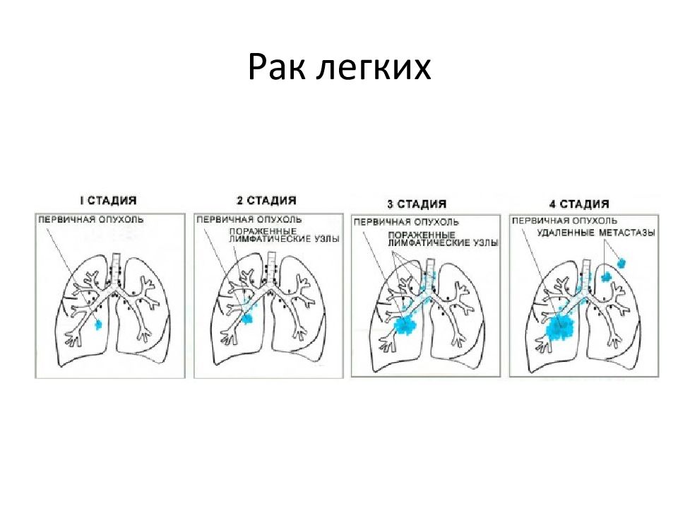 Стадии рака легкого картинки