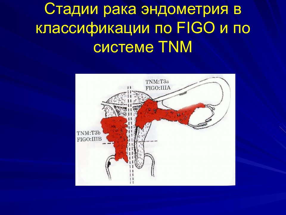 Рак тела матки картинки