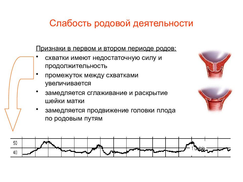 Слабость родовой деятельности презентация