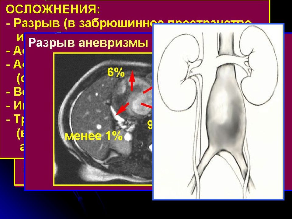 Аневризма брюшной аорты презентация