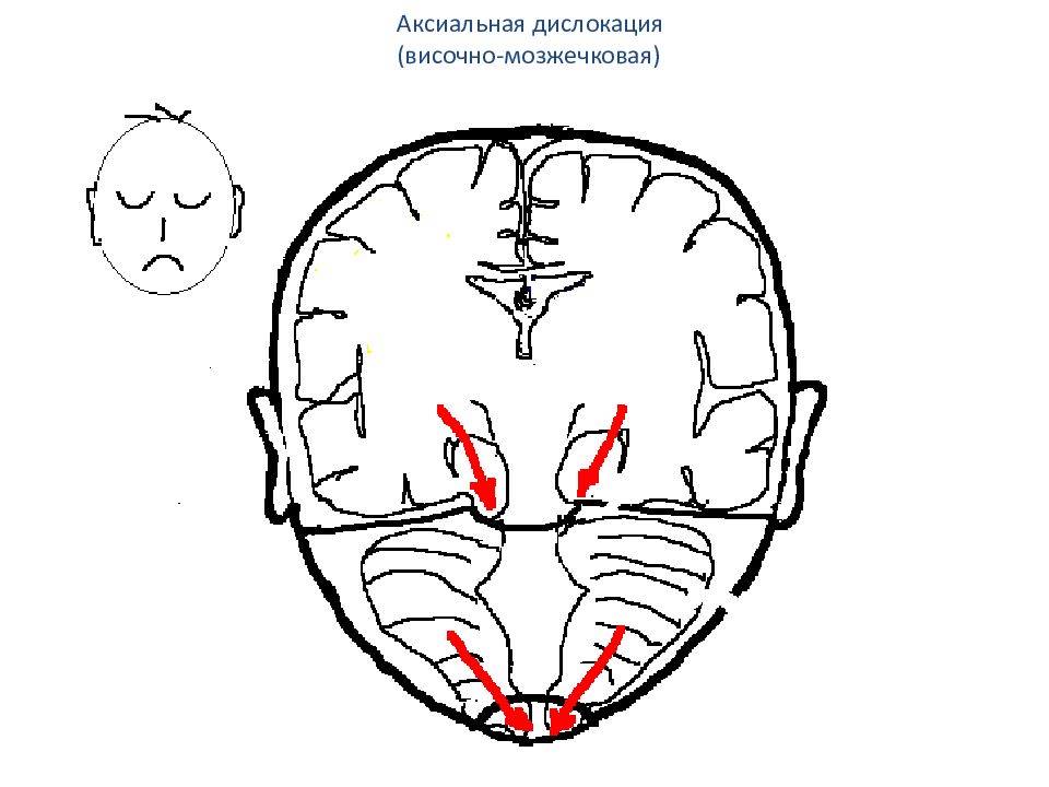 Дислокация головного мозга. Поперечная и аксиальная дислокация. Аксиальное смещение головного мозга.