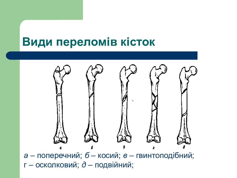 Перелом костей человека. Схема переломов трубчатых костей. Переломы длинных трубчатых костей. Переломы по направлению линии перелома.