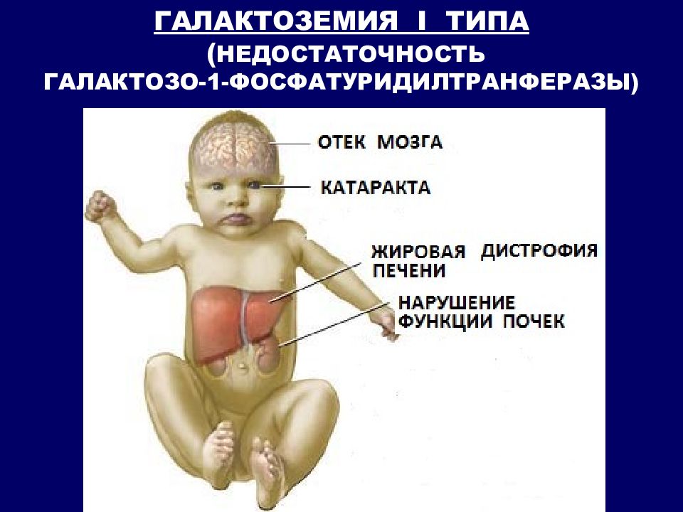 Клиническую картину галактоземии принято объяснять токсическим действием