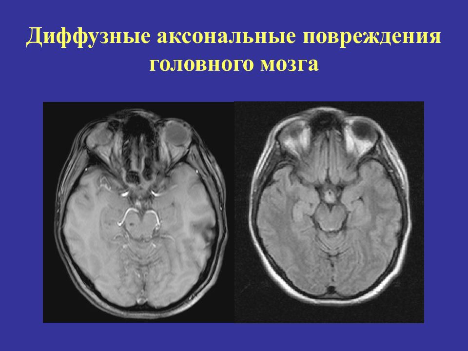 Диффузная травма. Диффузное аксональное повреждение кт. Диффузно аксональные повреждения головного мозга. Диффузное аксональное повреждение мозга кт. Диффузное аксональное повреждение головного мозга последствия.