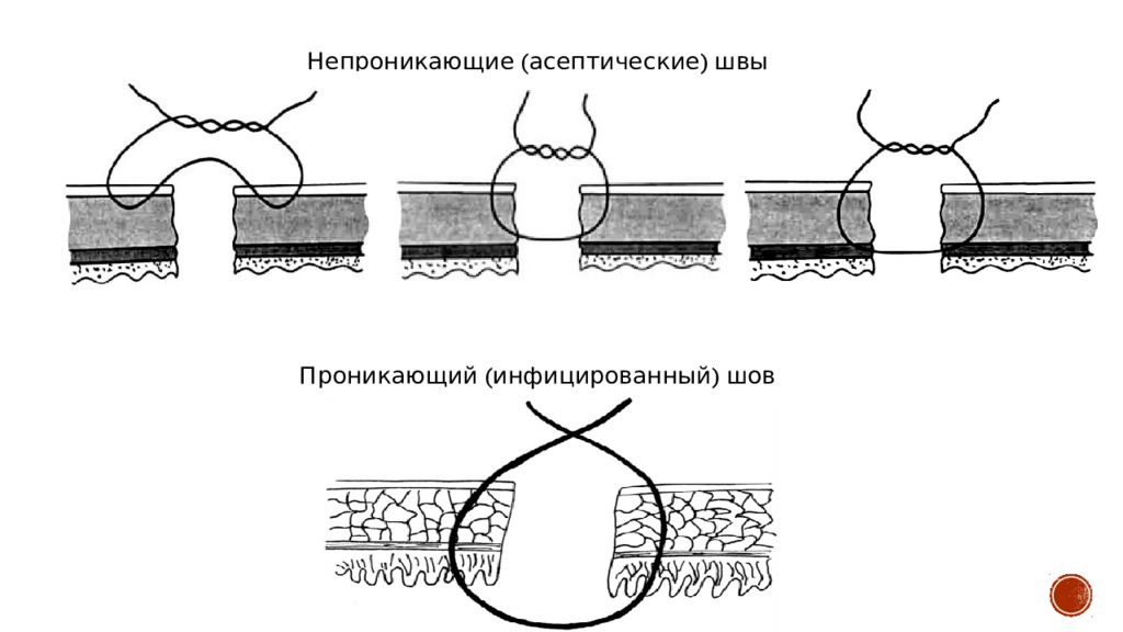 Жидкость шов. Асептические кишечные швы. Непроникающие кишечные швы. Проникающие кишечные швы. Серозно мышечно подслизистый шов.