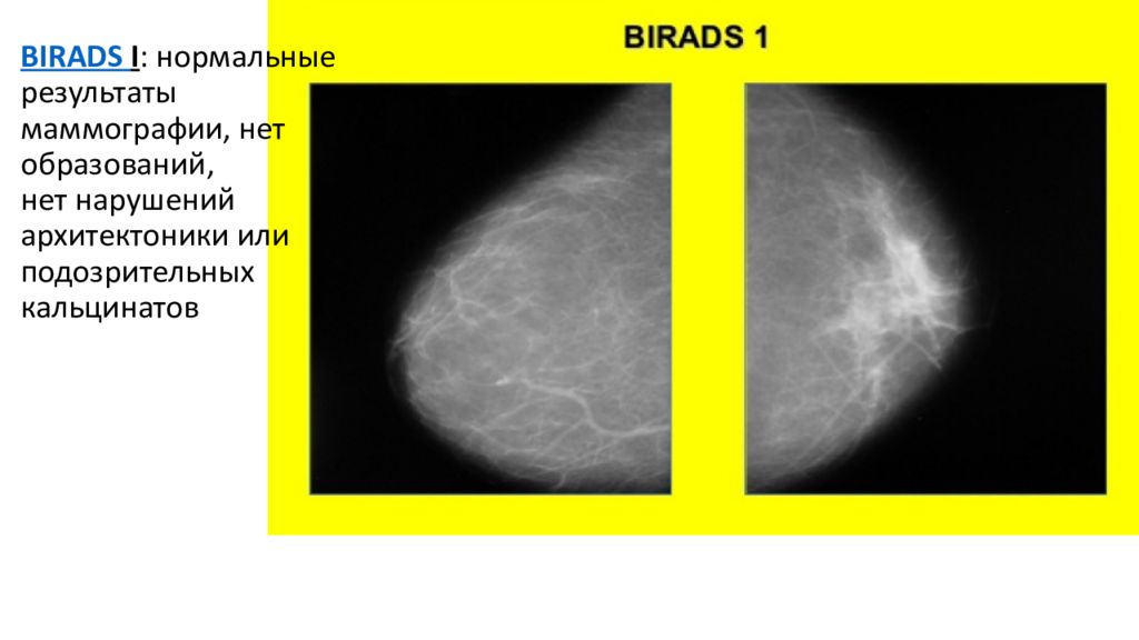 Справа bi rads 2. Маммография молочных желез bi rads 4. Классификация bi-rads молочных желез. Классификация bi-rads молочных желез в маммографии. Маммография молочных желез bi rads 1.