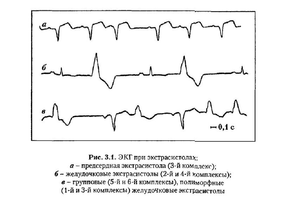 Желудочковая экс. Желудочковая экстрасистолия на ЭКГ. Предсердные экстрасистолы на ЭКГ. ЭКГ монотопные желудочковые экстрасистолы. Наджелудочковая экстрасистола на ЭКГ.