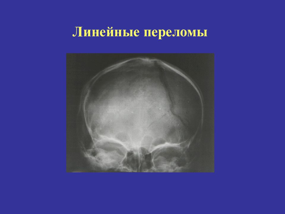 Линейная трещина. Линейный перелом затылочной кости у ребенка. Линейный перелом черепа. Линейный перелом теменной кости.