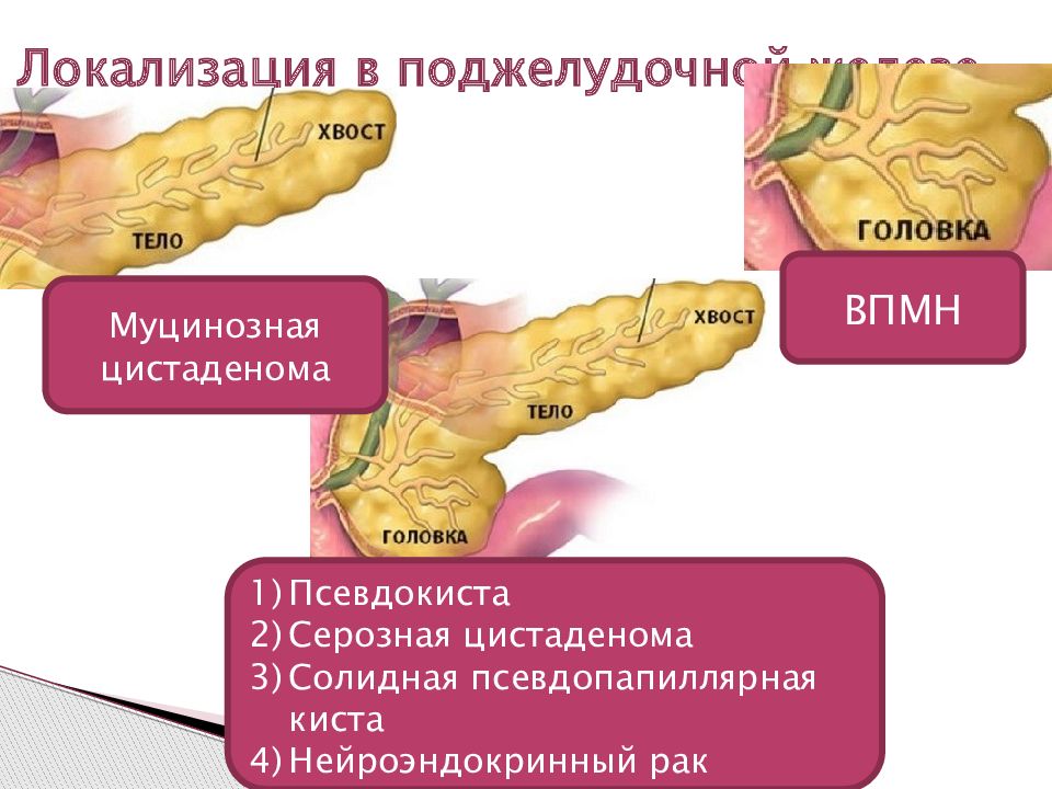 Муцинозная цистаденома поджелудочной железы. Острый панкреатит в хвосте. Поджелудочная онкология признаки.