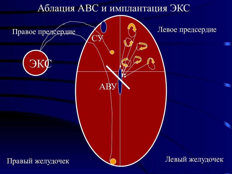 Аблация