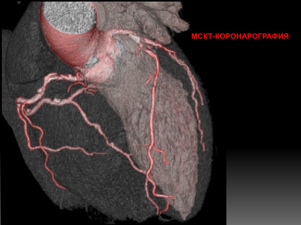 Мскт артерий. Кальциноз коронарных артерий на кт. Коронарные артерии на коронарографии. Кт коронарография сосудов сердца. Кт-ангиография коронарных артерий.
