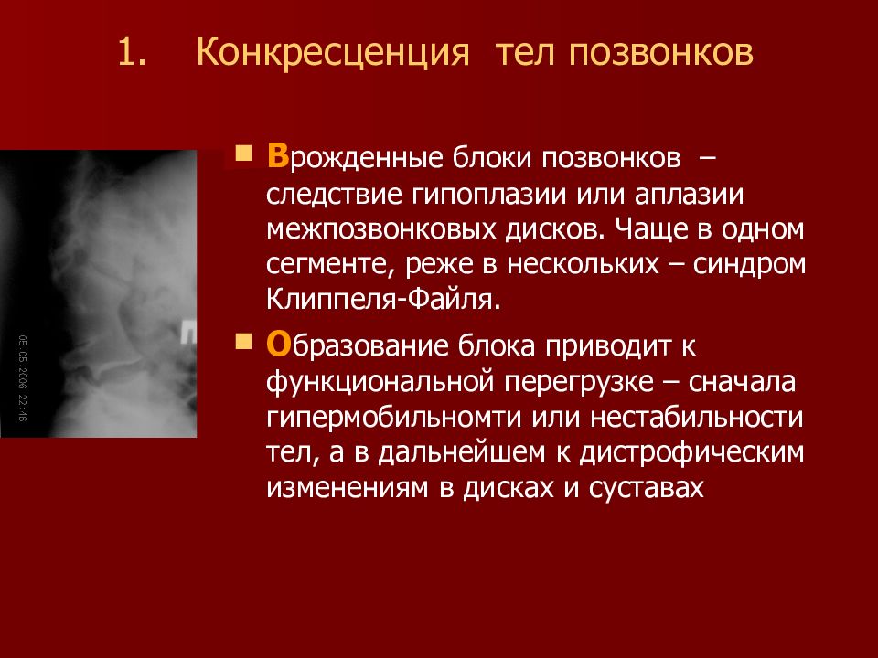 Конкресценция позвонков. Конкресценция шейных позвонков с2-с3 рентген. Конкресценция тел позвонков. Конкресценция позвонков это. Частичная конкресценция тел позвонков.