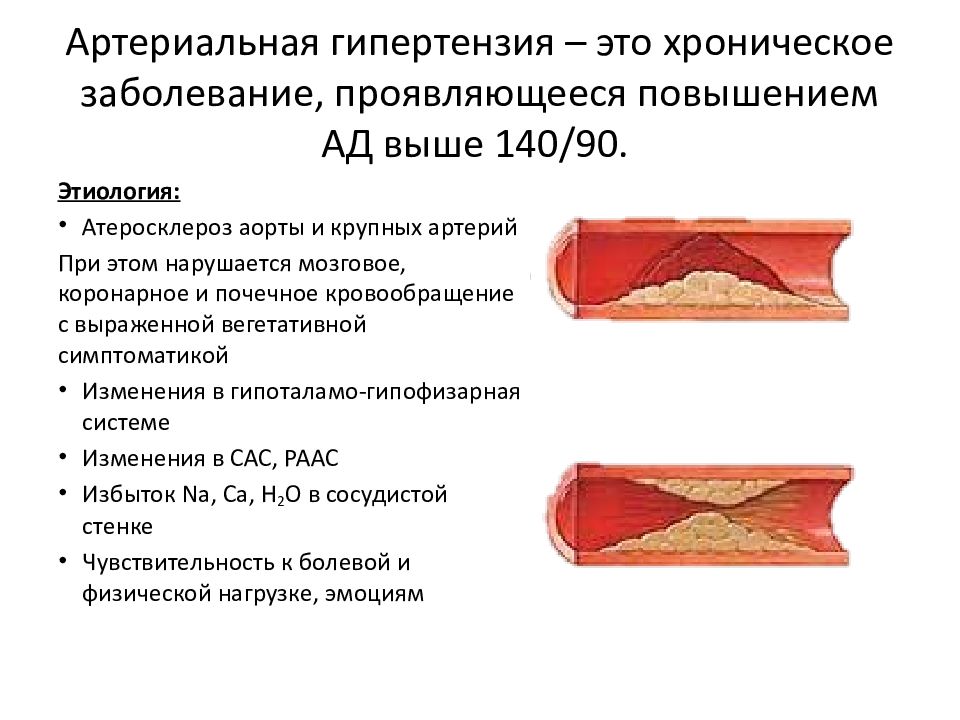 При атеросклерозе повышается. Артериальная гипертензия при атеросклерозе аорты. Поражение сосудов при артериальной гипертензии может проявляться. Артериальная гипертензия и атеросклероз. Атеросклероз при артериальной гипертензии.