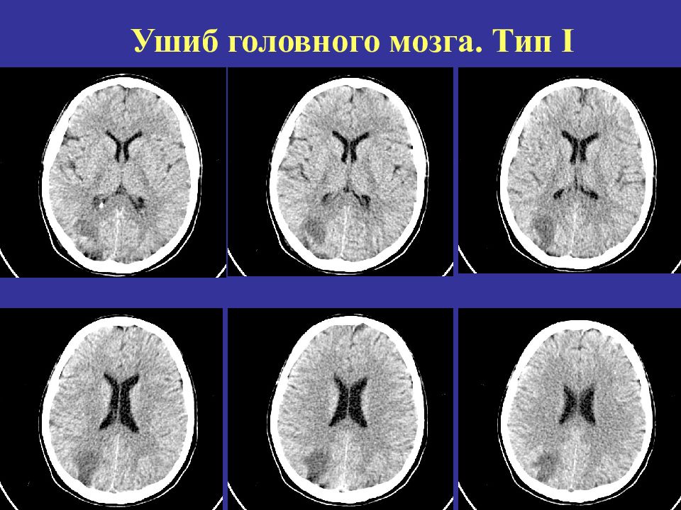 Диагноз головы. Ушиб головного мозга 2 типа кт. Ушиб головного мозга 1 типа кт. Очаги ушиба головного мозга на кт. Кт головного мозга ушиб мозговой ткани 2 типа.