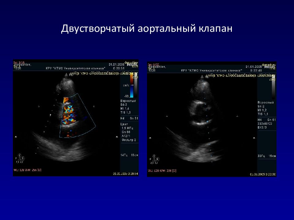 Порок двухстворчатого клапана. ВПС 2 створчатый аортальный клапан. Двустворчатый аортальный клапан на УЗИ. Двухстворчатый аортальный клапан на ЭХОКГ. 2 Створчатый аортальный клапан на УЗИ.